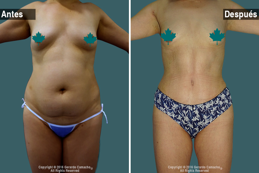 Resultados impecables de abdominoplastia en Bogotá